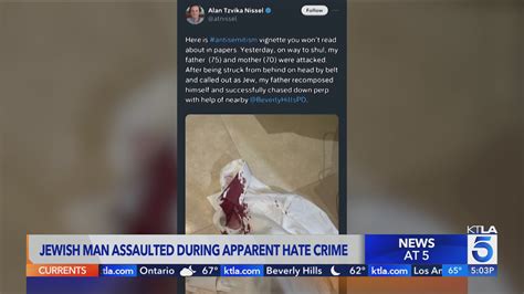 Jewish man beaten during apparent hate crime in Beverly Hills speaks out
